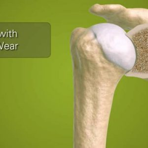 Exactech Equinoxe Baseplates for Medial Wear in Shoulder Arthroplasty - 718-00-05