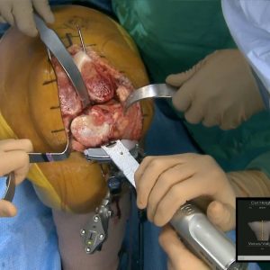 Exactech Truliant Primary Knee Live Surgery with Dr. Morrison - 12-0000526